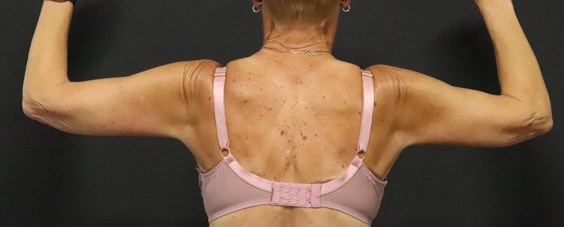 Arm lift (brachioplasty) after, Posterior view
