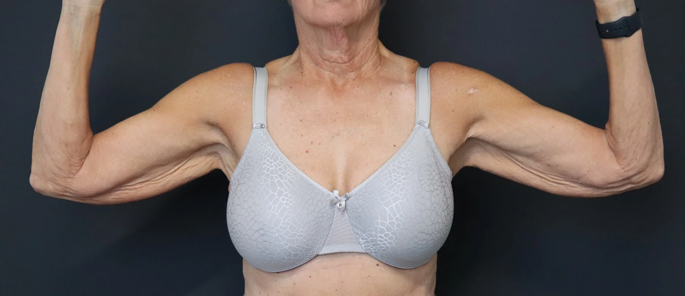 Arm lift (brachioplasty) before, Frontal view