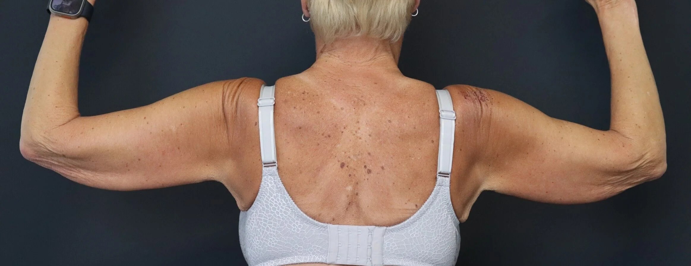 Arm lift (brachioplasty) before, Posterior view