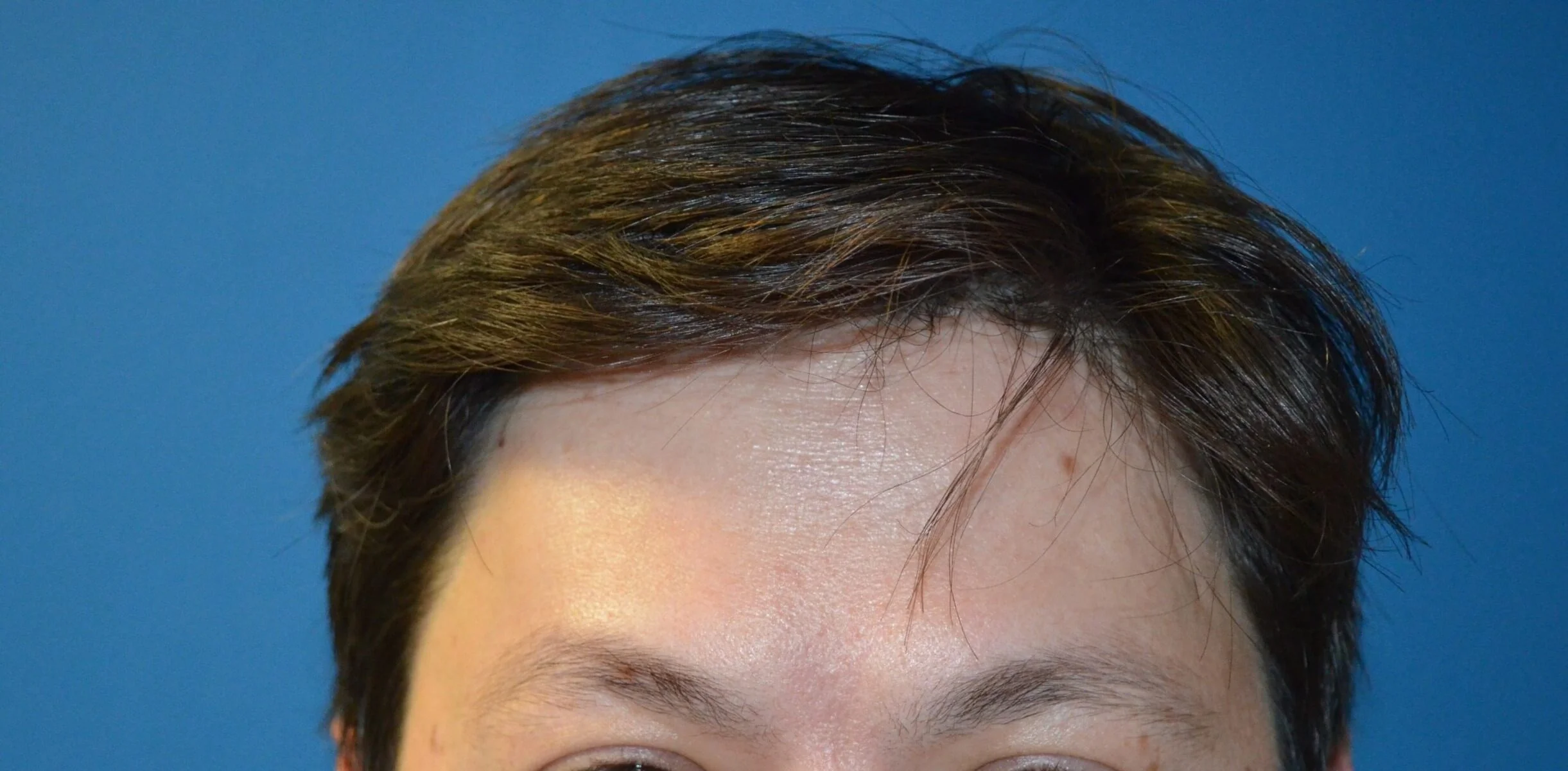 Forehead at maximal elevation, day 9