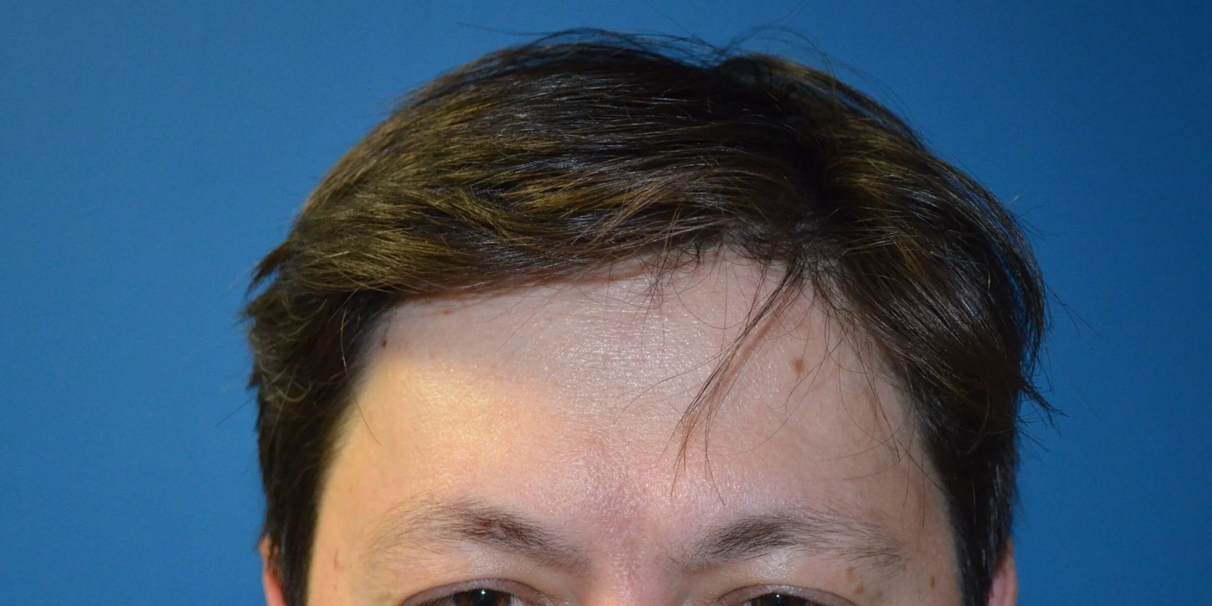 Glabella on maximal frown, day 9