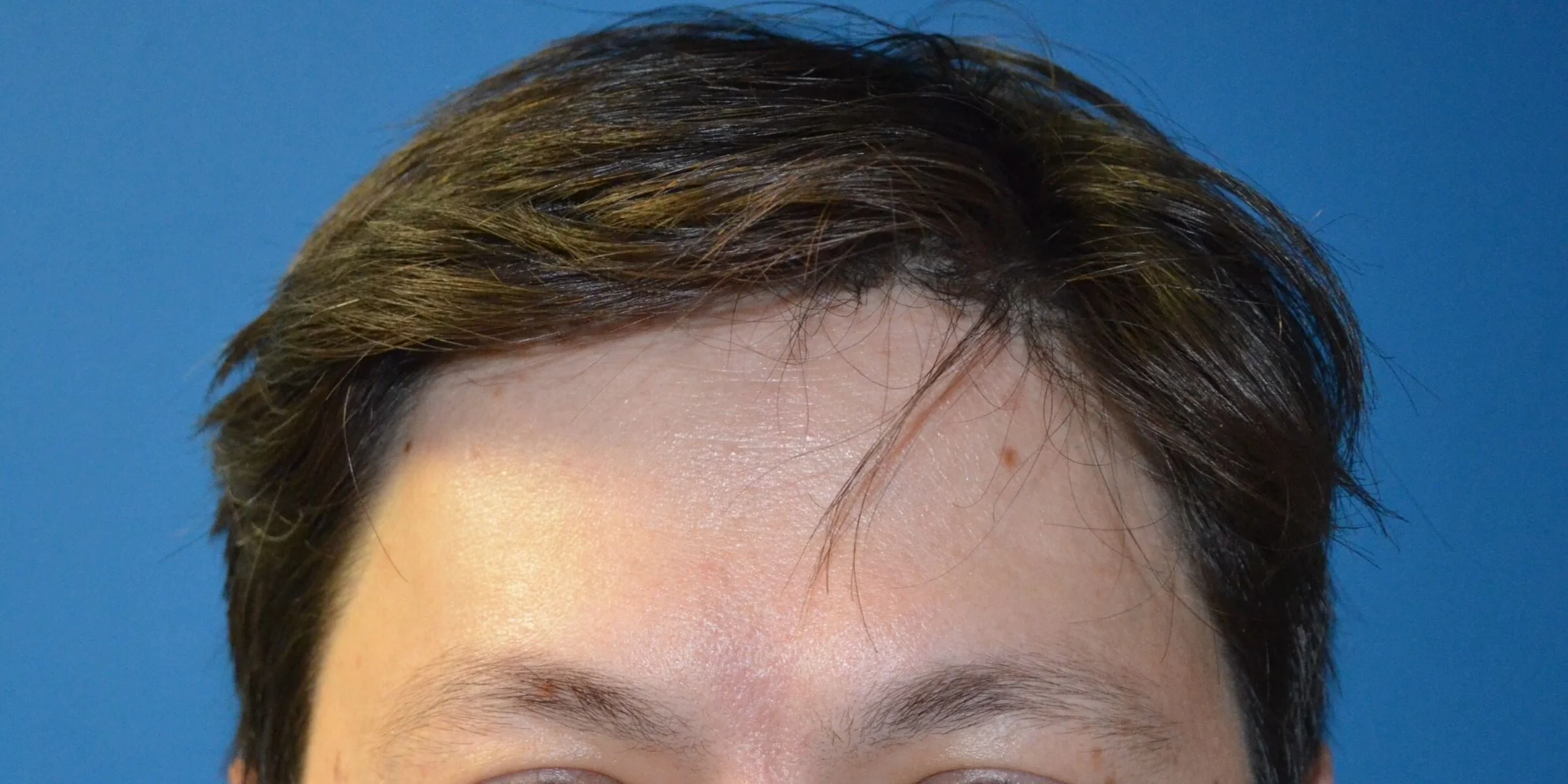 Forehead at rest, day 9 after Botox and Dysport