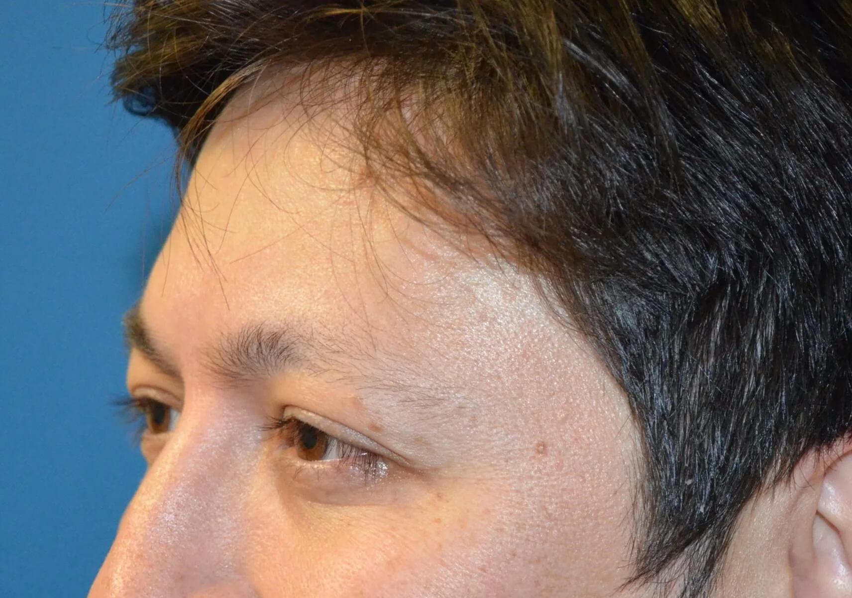 Left side of face smiling, day 9 after neuromodulator