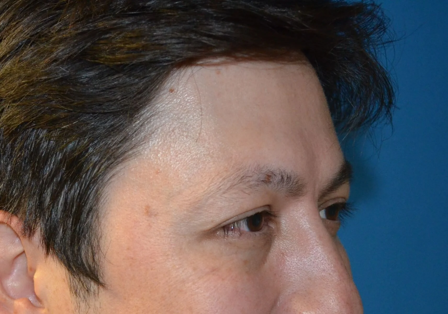 Right side of face smiling, day 9 after neuromodulator