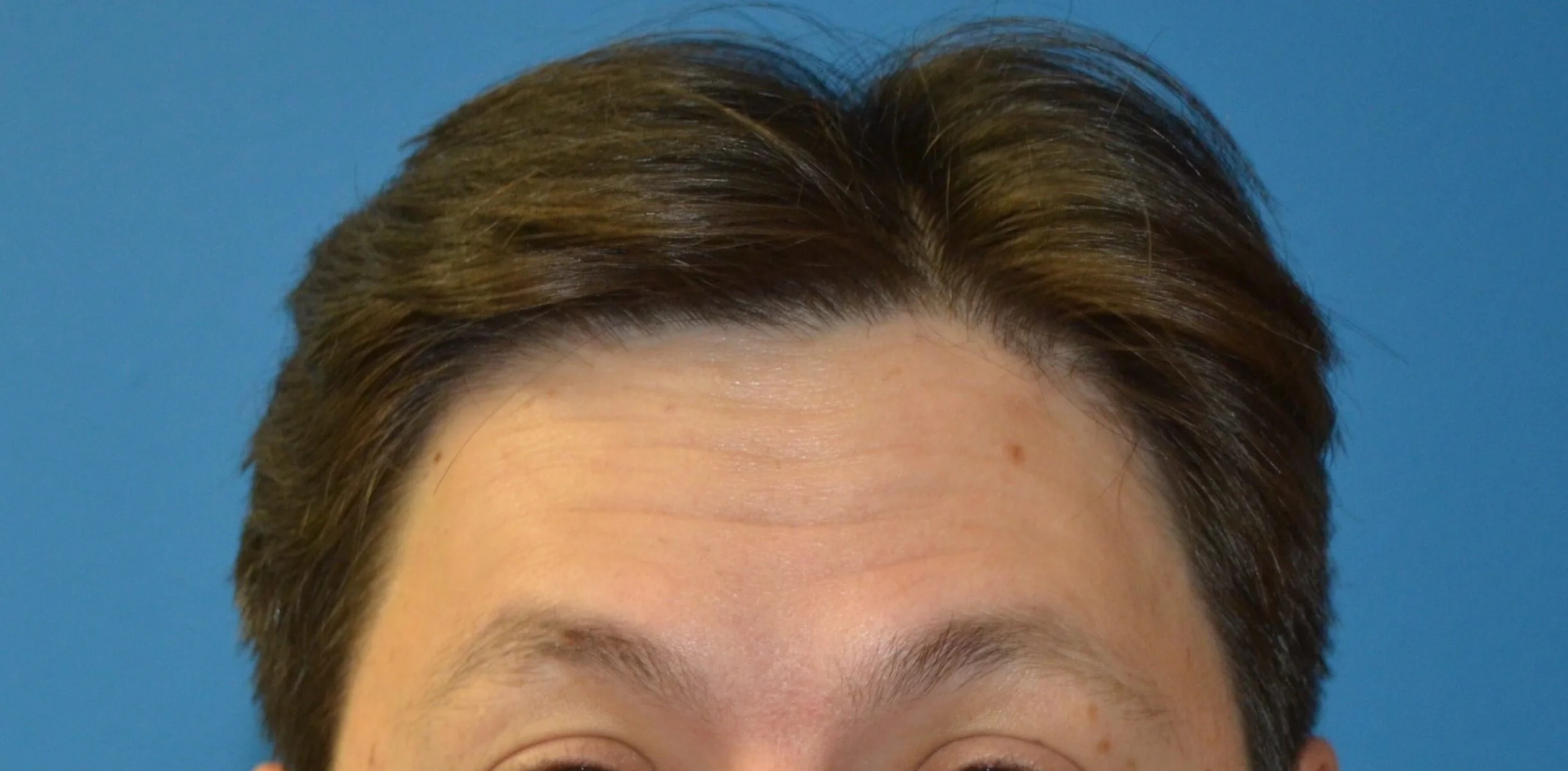 Forehead at maximal elevation before treatment