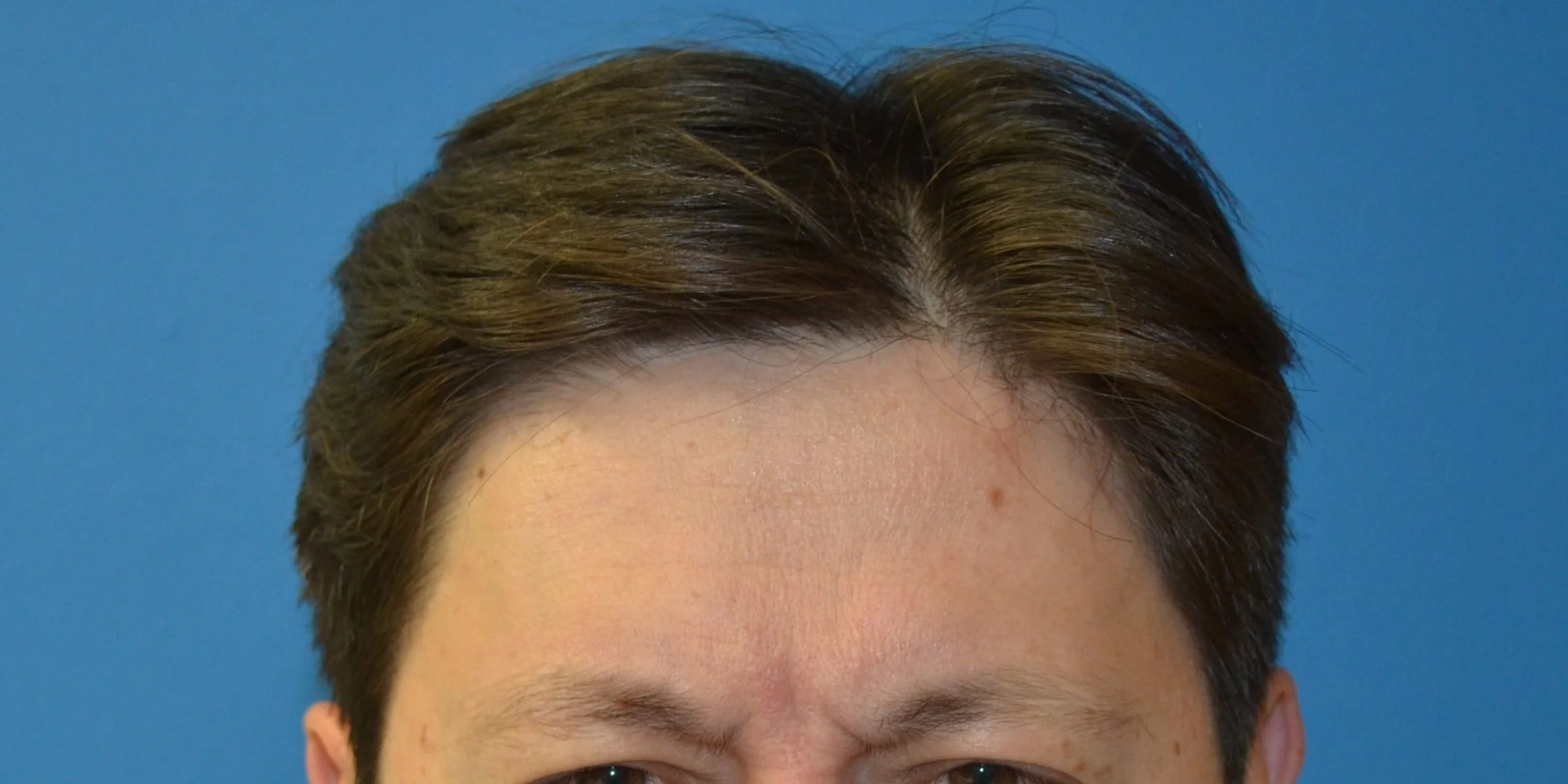 Glabella on maximal frown before treatment