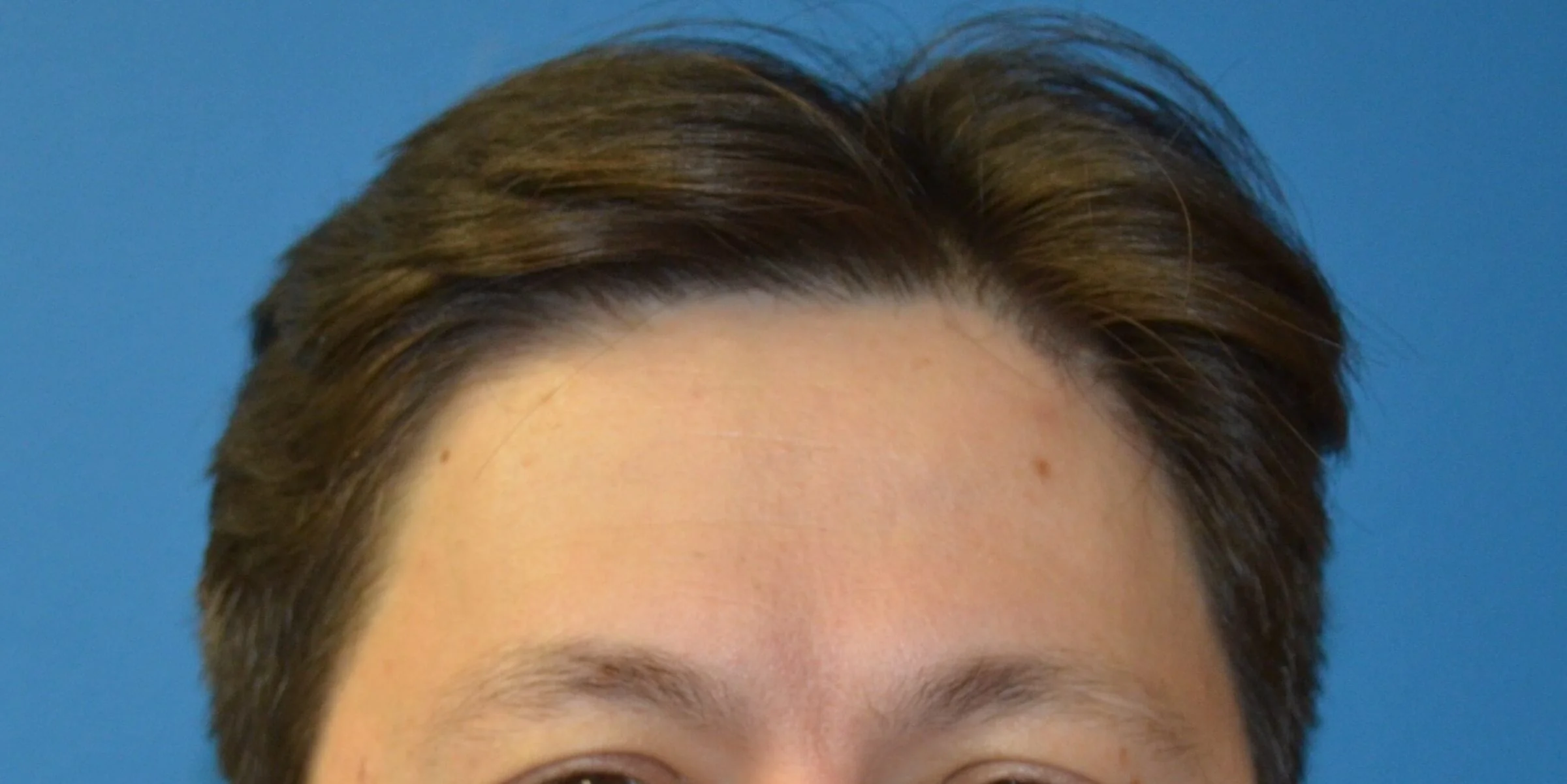 Forehead at rest before Botox and Dysport