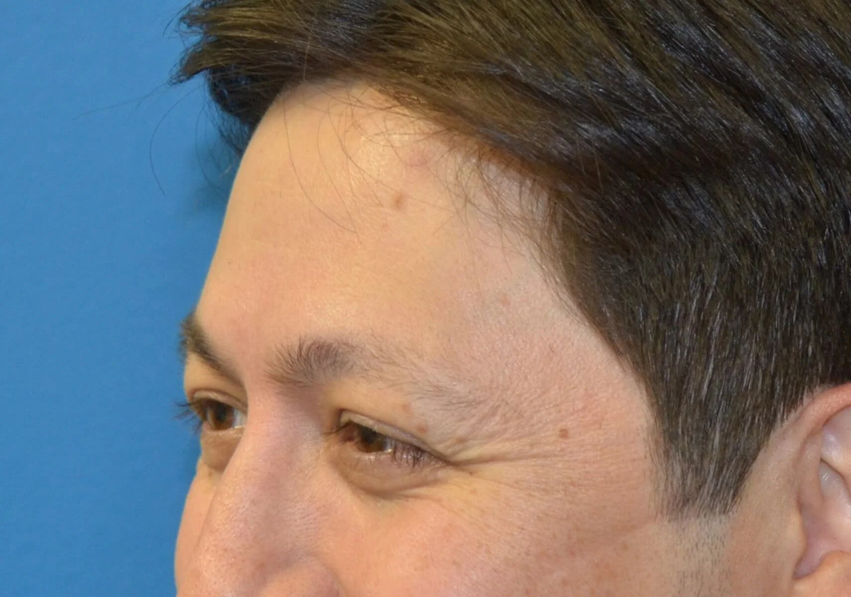 Left side of face smiling before Botox and Dysport
