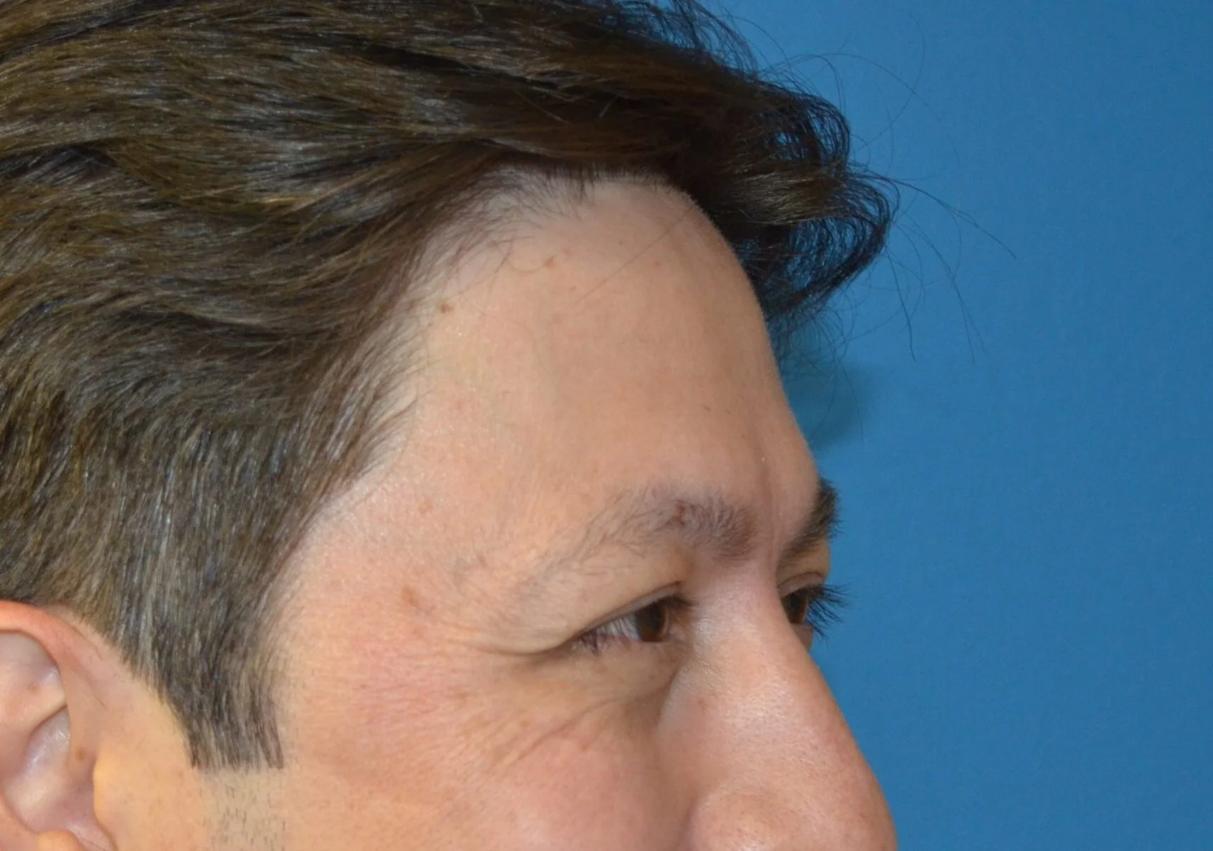 Right side of face smiling before Botox and Dysport