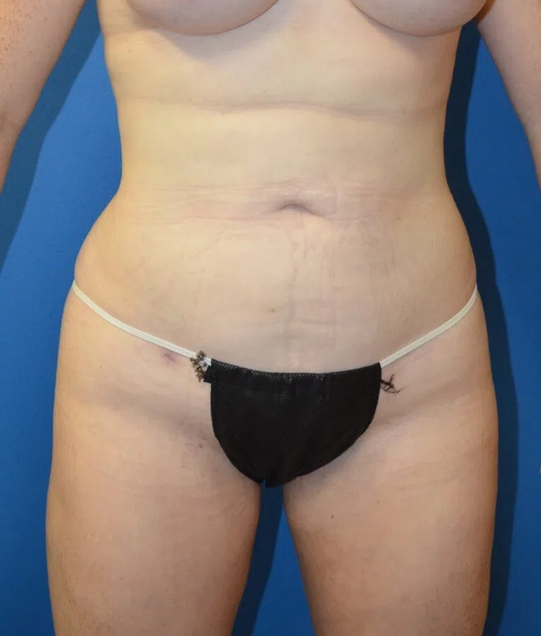 Brazilian Butt Lift after, Frontal view
