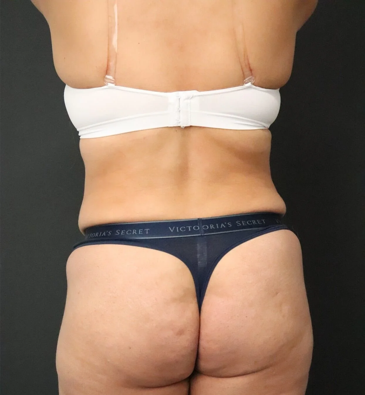Brazilian Butt Lift after, Posterior view