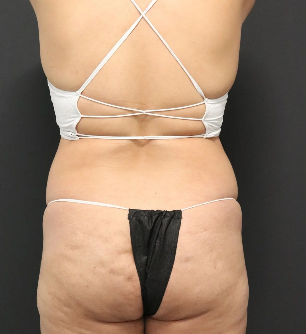 Brazilian Butt Lift before, Posterior view
