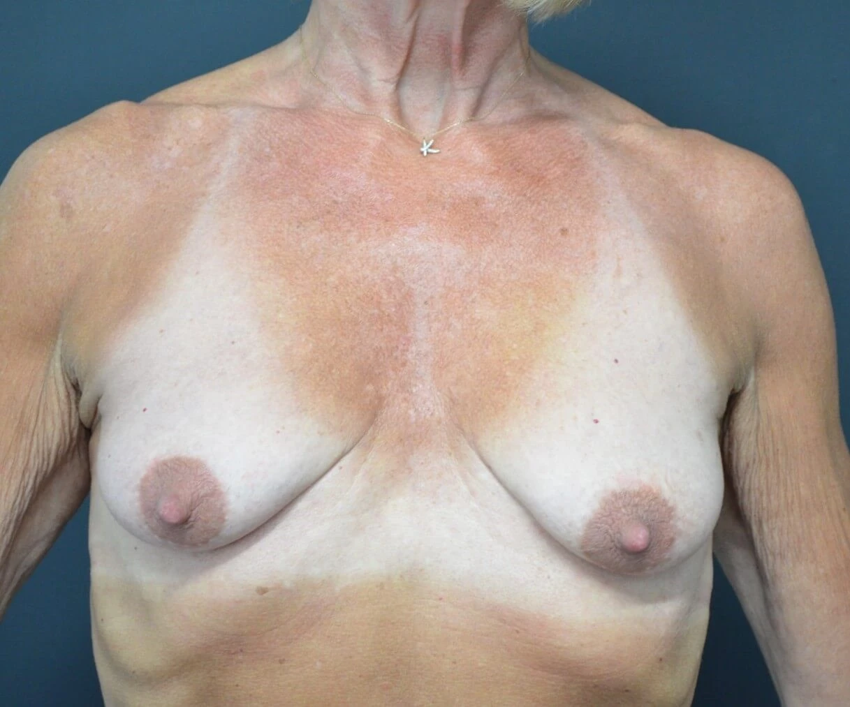 Augmentation Mastopexy before — Austin TX patient frontal