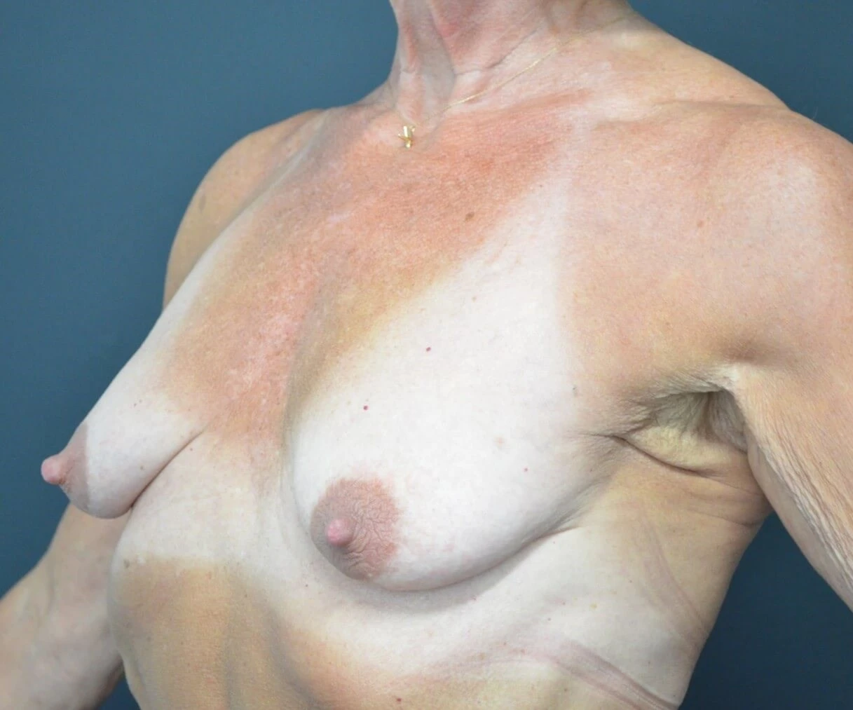 Augmentation Mastopexy before — case 1, Austin TX