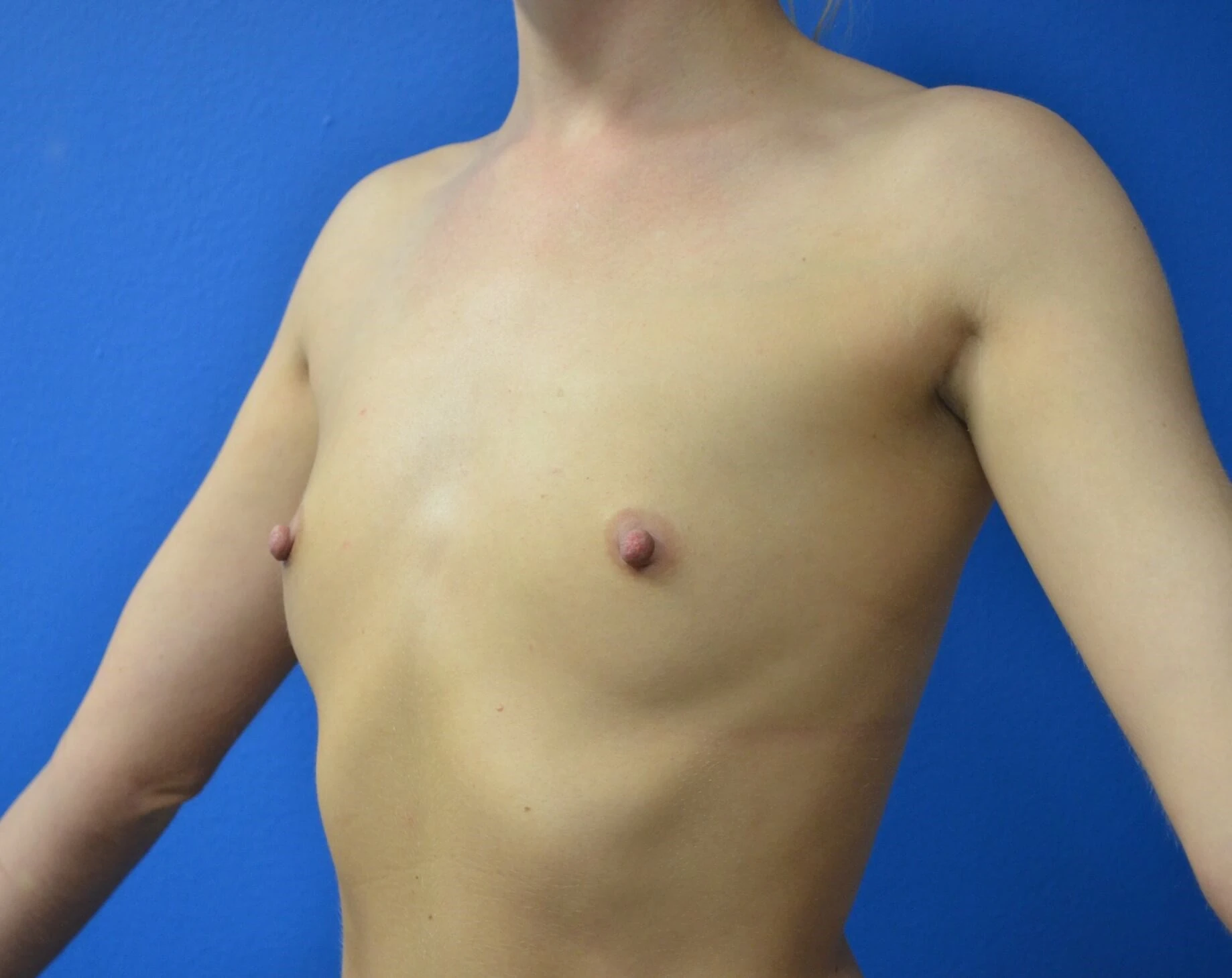 Breast Augmentation before — case 25, Austin TX