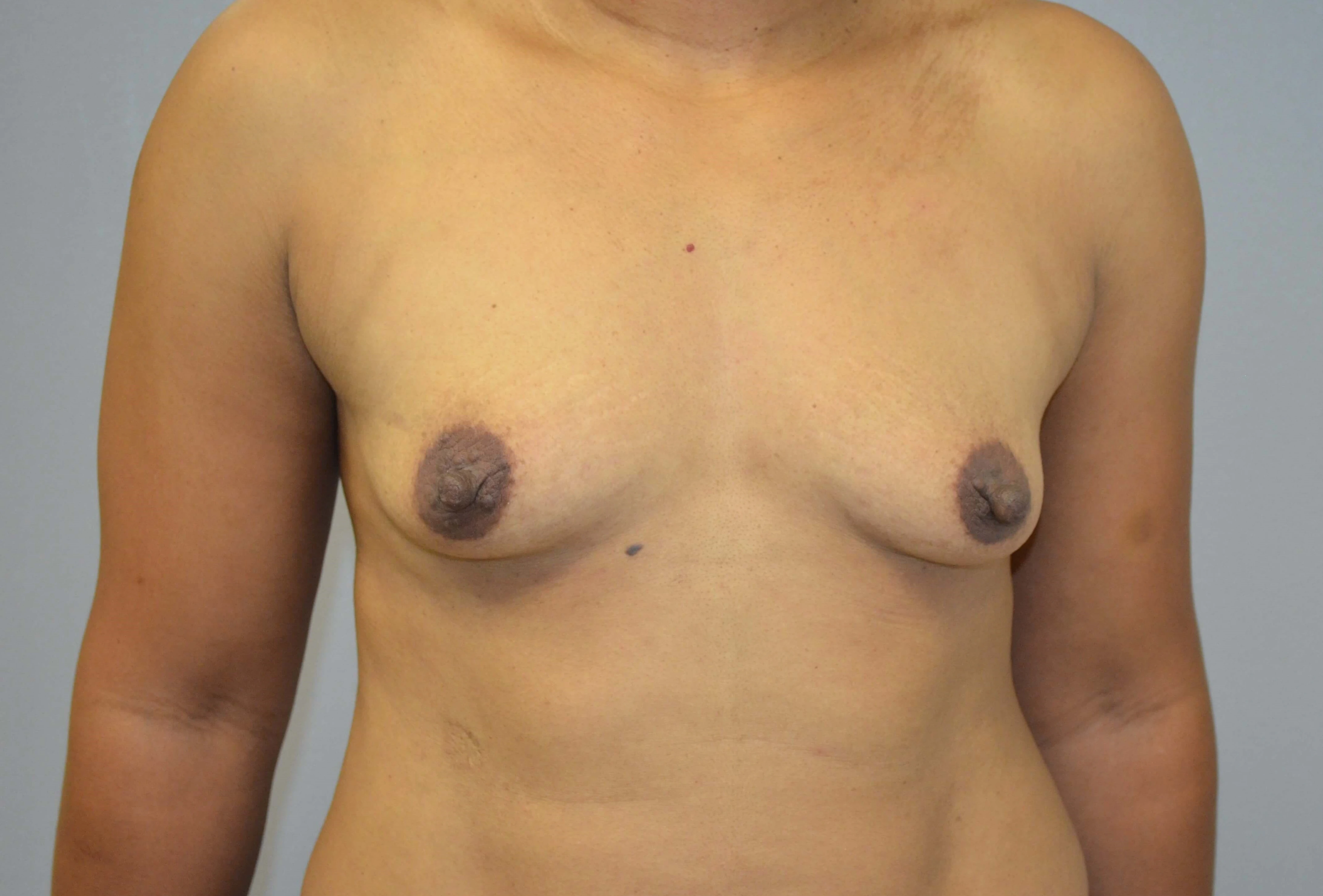 Breast Augmentation before — case 30, Austin TX