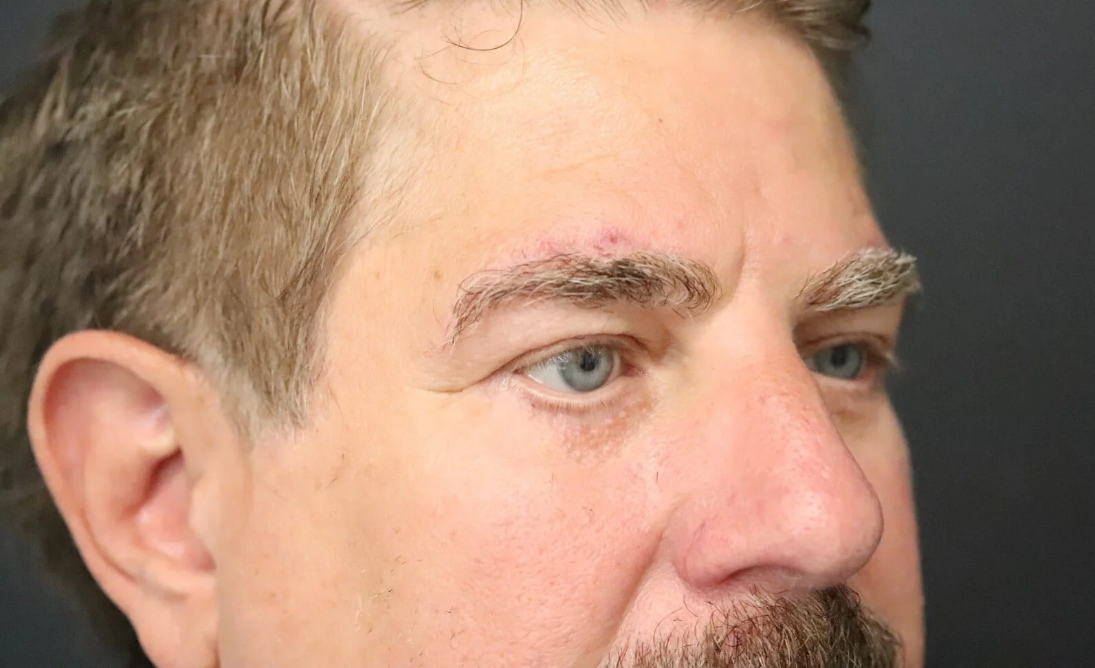 Brow Lift after — case 2, Austin TX