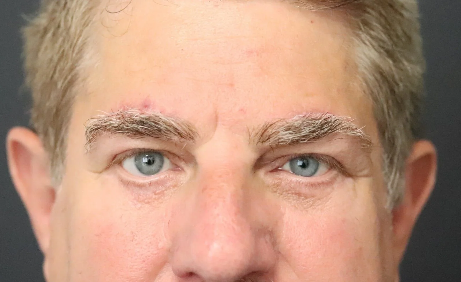 Brow lift Austin TX