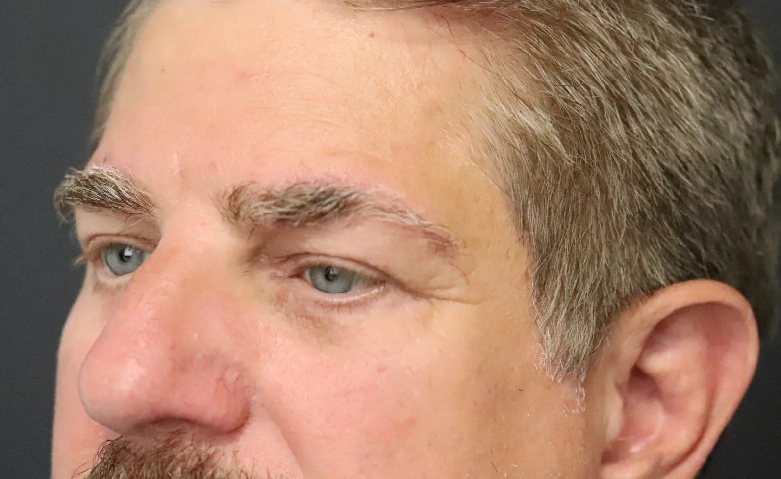 Brow Lift after — case 4, Austin TX