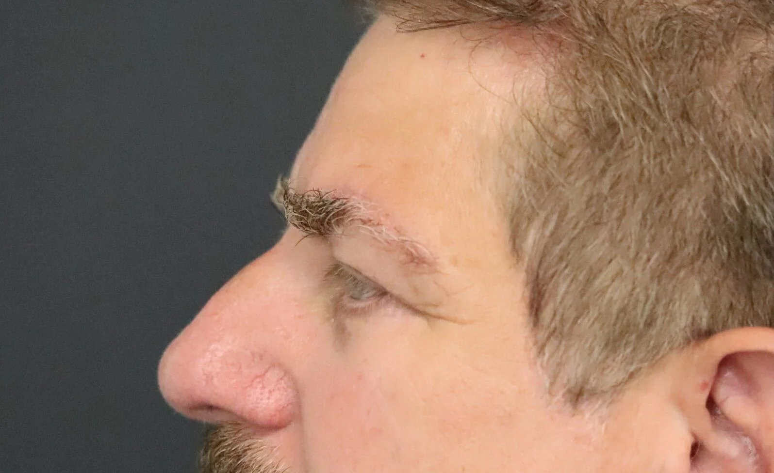 Brow Lift after — case 5, Austin TX