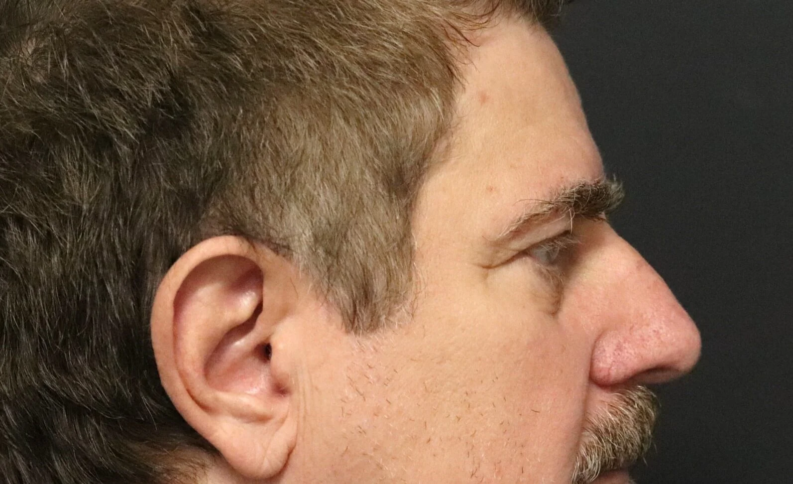 Brow lift before — Austin TX patient frontal