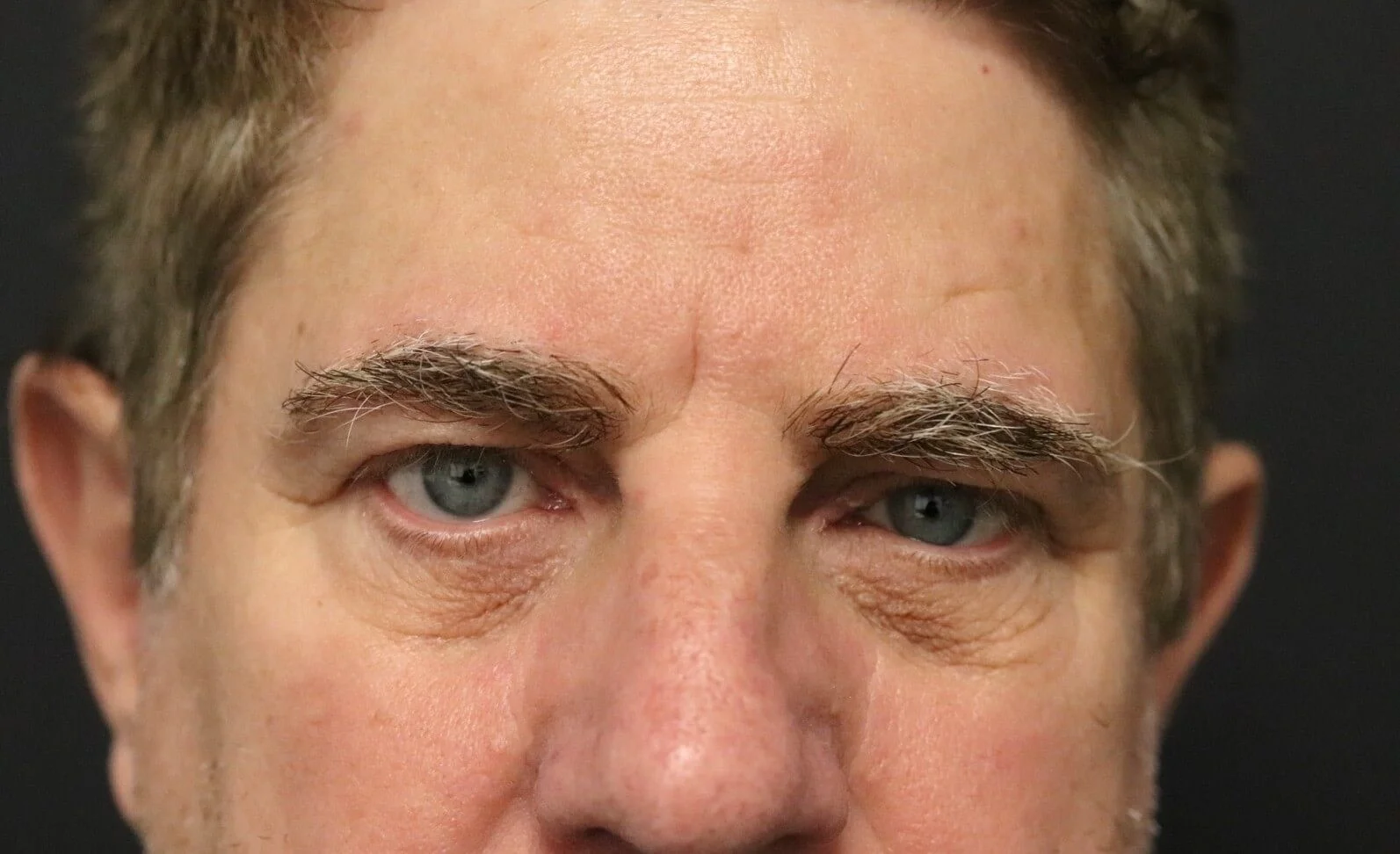Brow Lift before — case 3, Austin TX