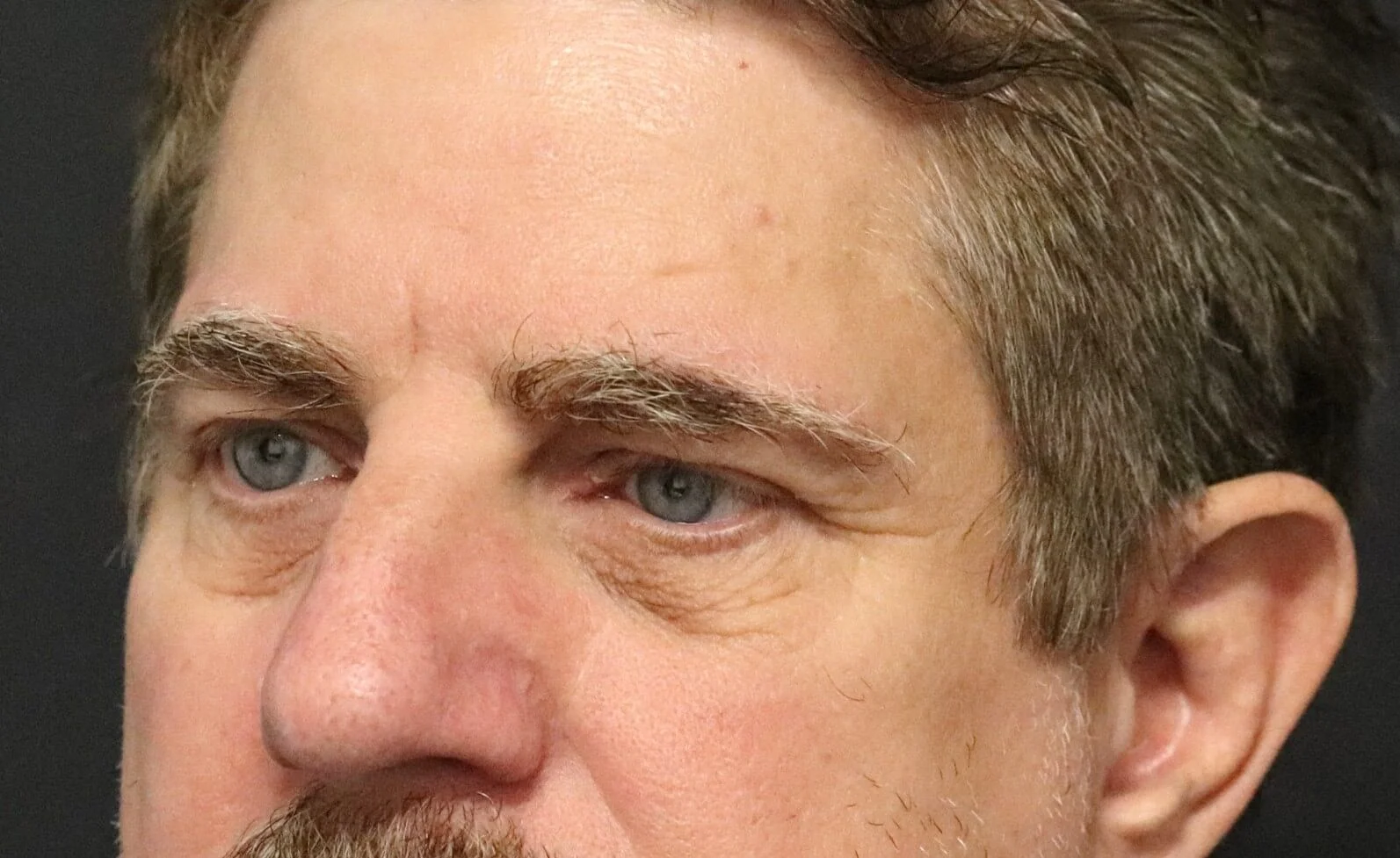 Brow Lift before — case 4, Austin TX