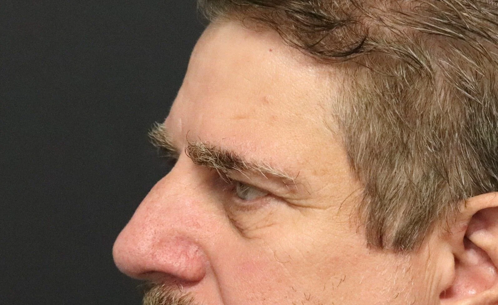 Brow Lift before — case 5, Austin TX