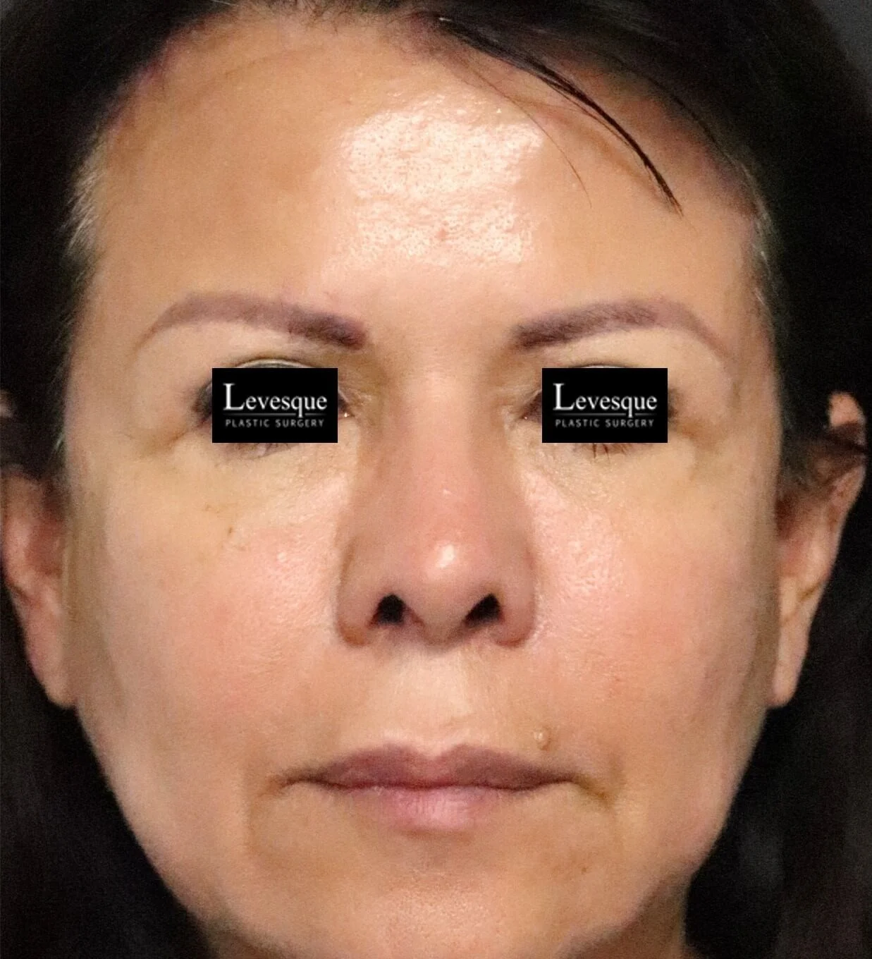 Brow lift after — Austin TX patient frontal