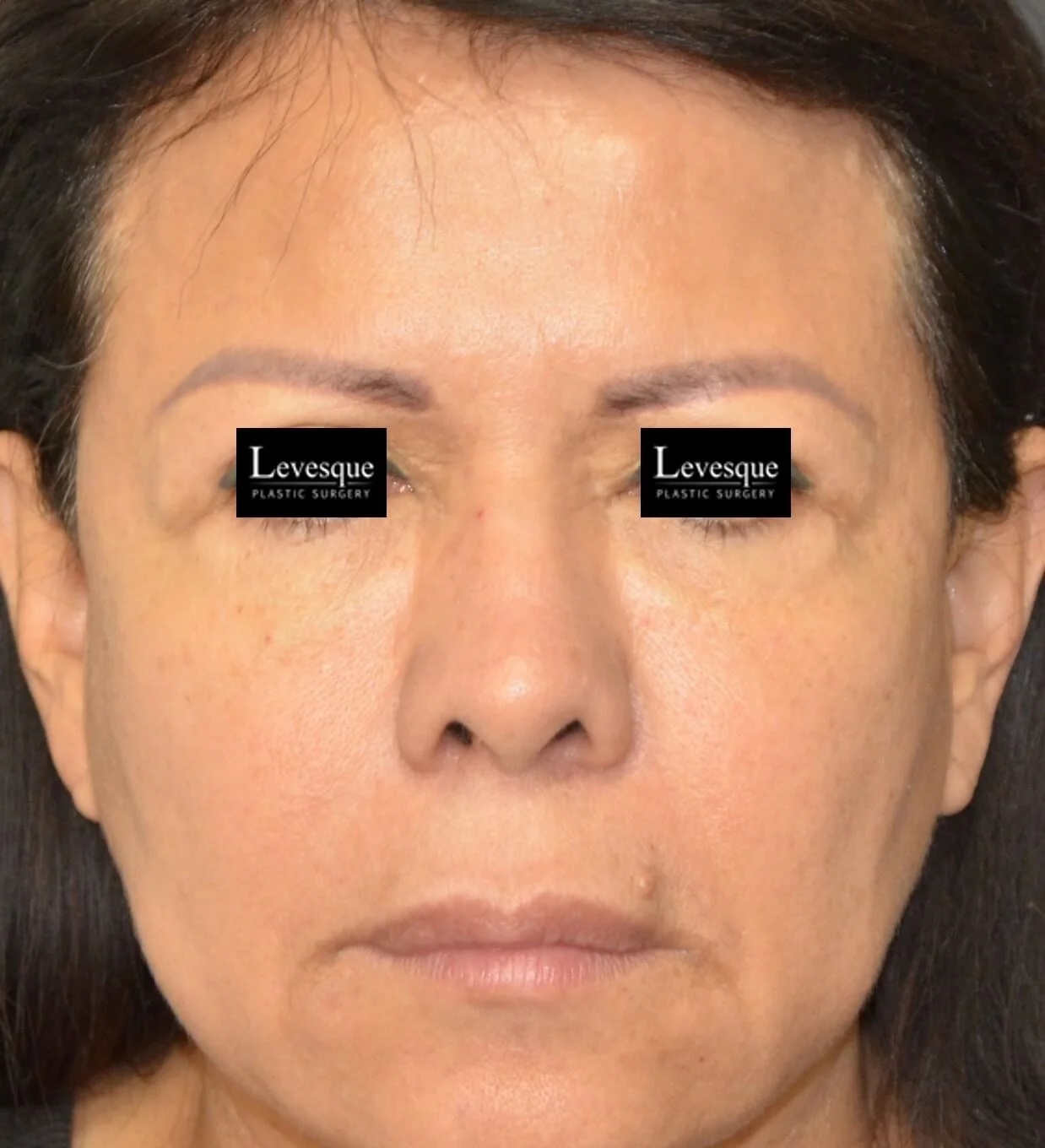 Brow Lift before — case 2, Austin TX