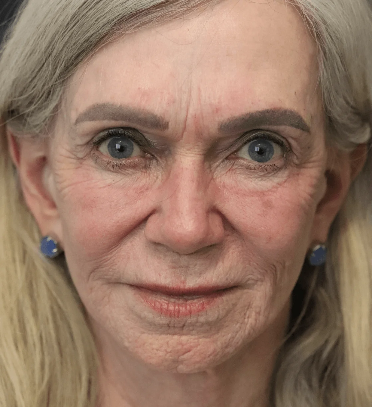 CO2 laser resurfacing after, Frontal view