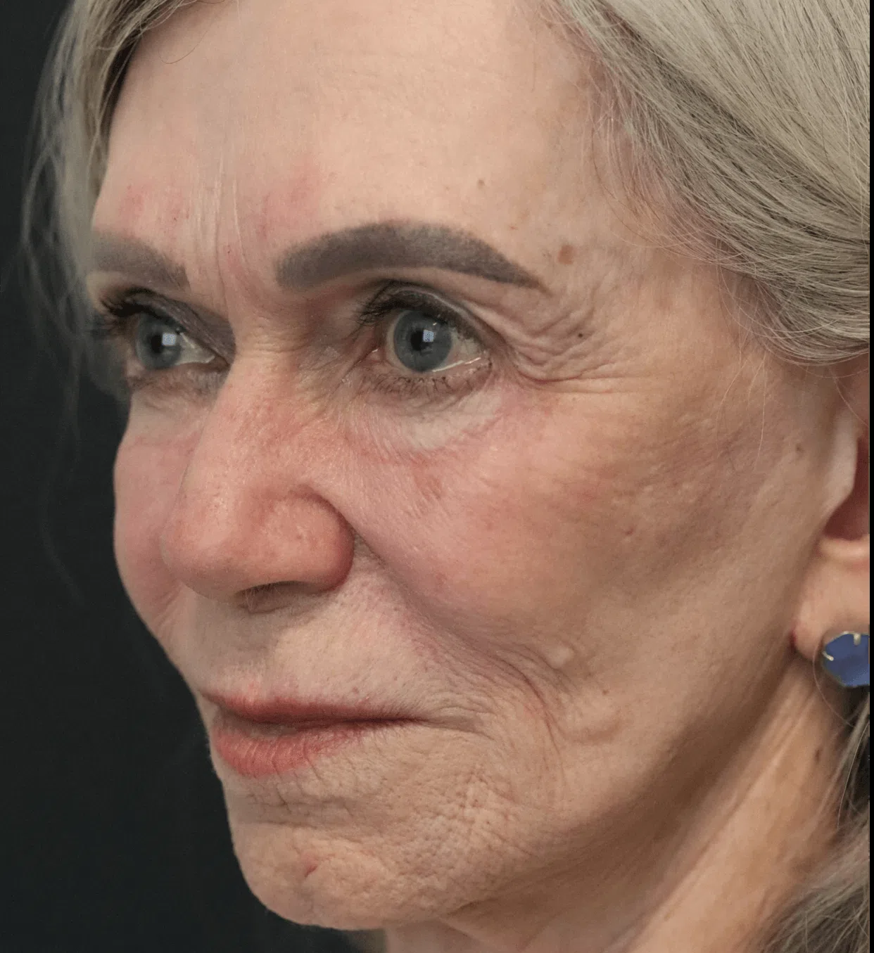 CO2 laser resurfacing after, Left Oblique view