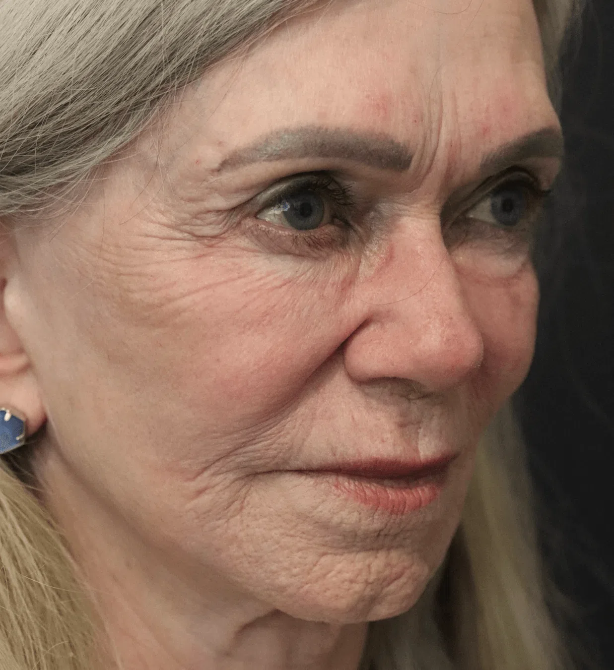 CO2 laser resurfacing after, Right Oblique view