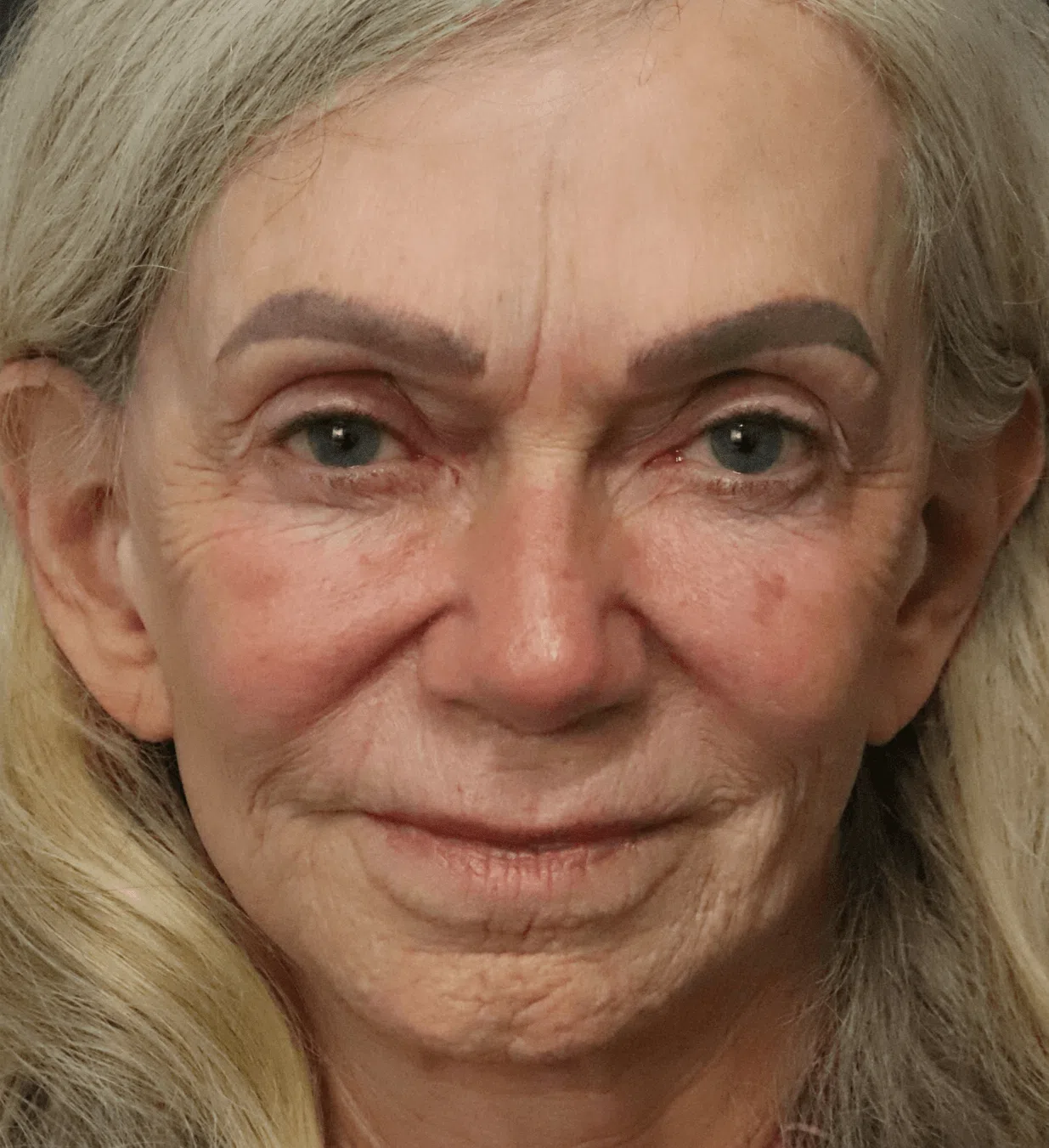 CO2 laser resurfacing before, Frontal view