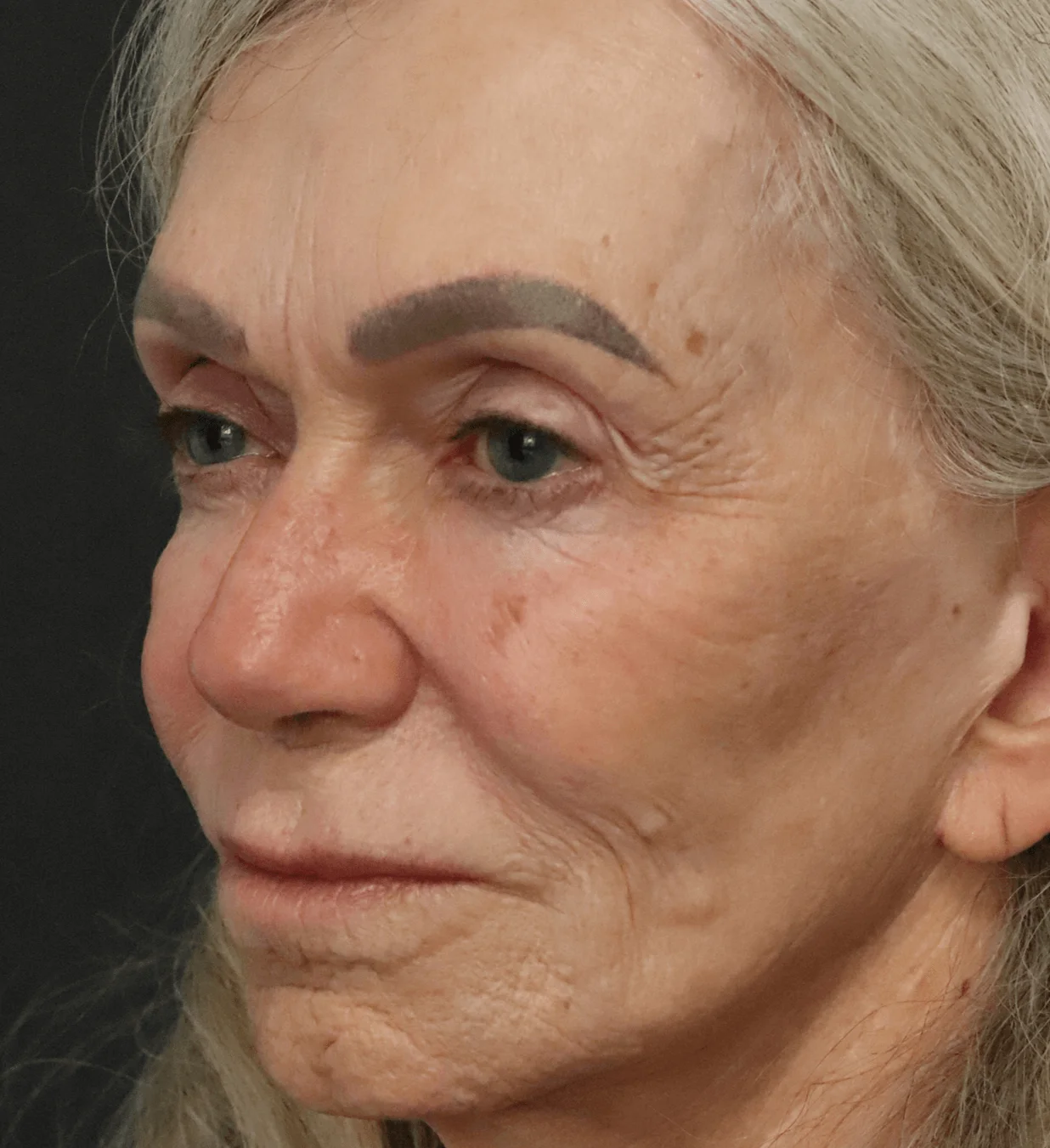 CO2 laser resurfacing before, Left Oblique view