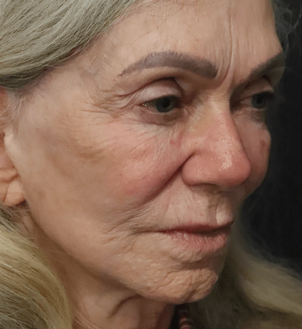 CO2 laser resurfacing before, Right Oblique view