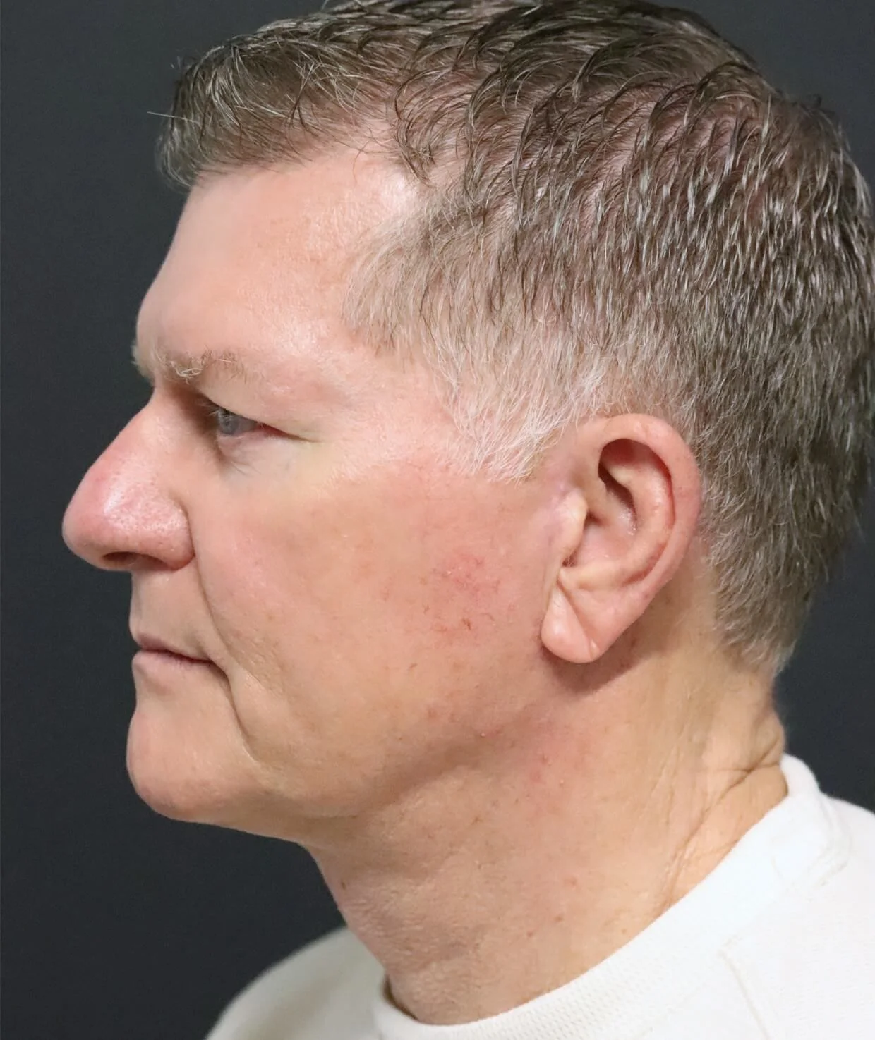 Male deep plane facelift and neck lift — after, left lateral view