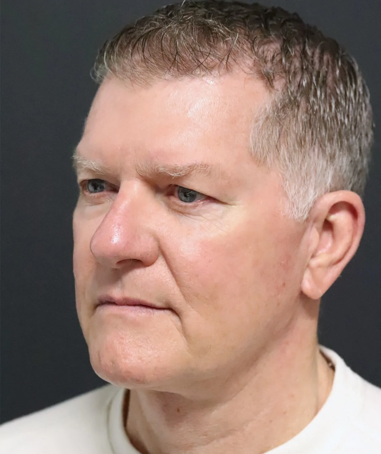 Deep plane facelift after — case 1, Austin TX