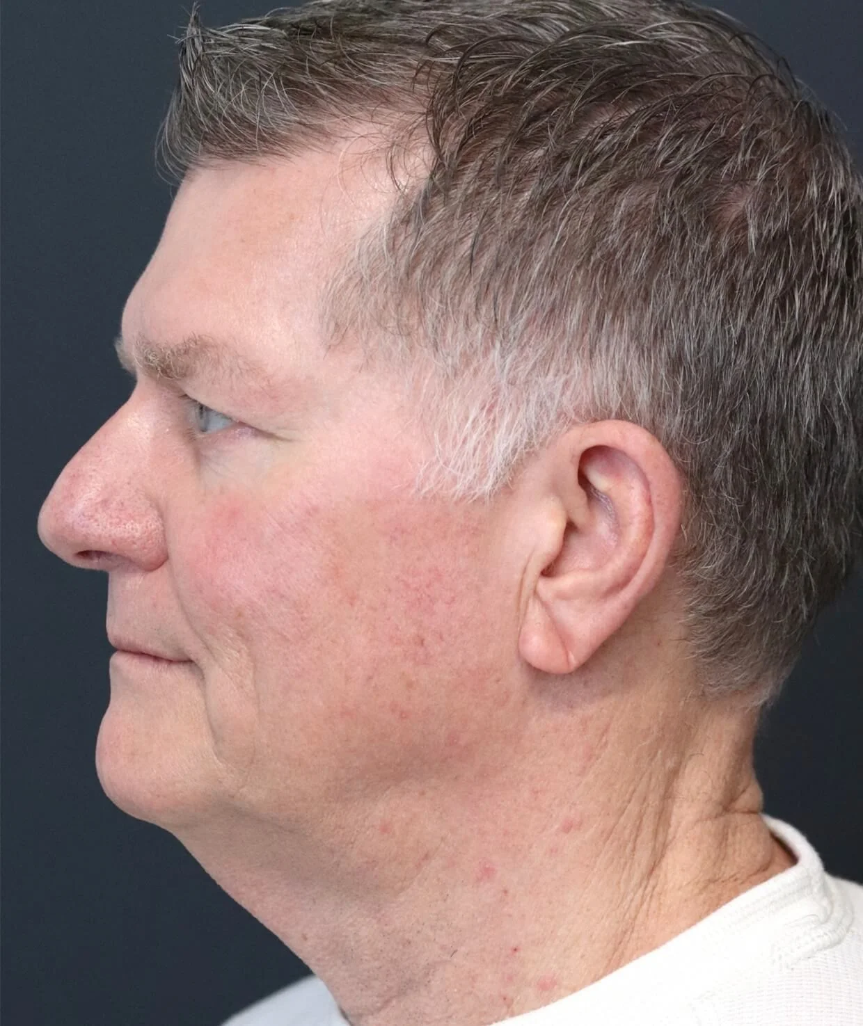 Male deep plane facelift and neck lift — before, left lateral view