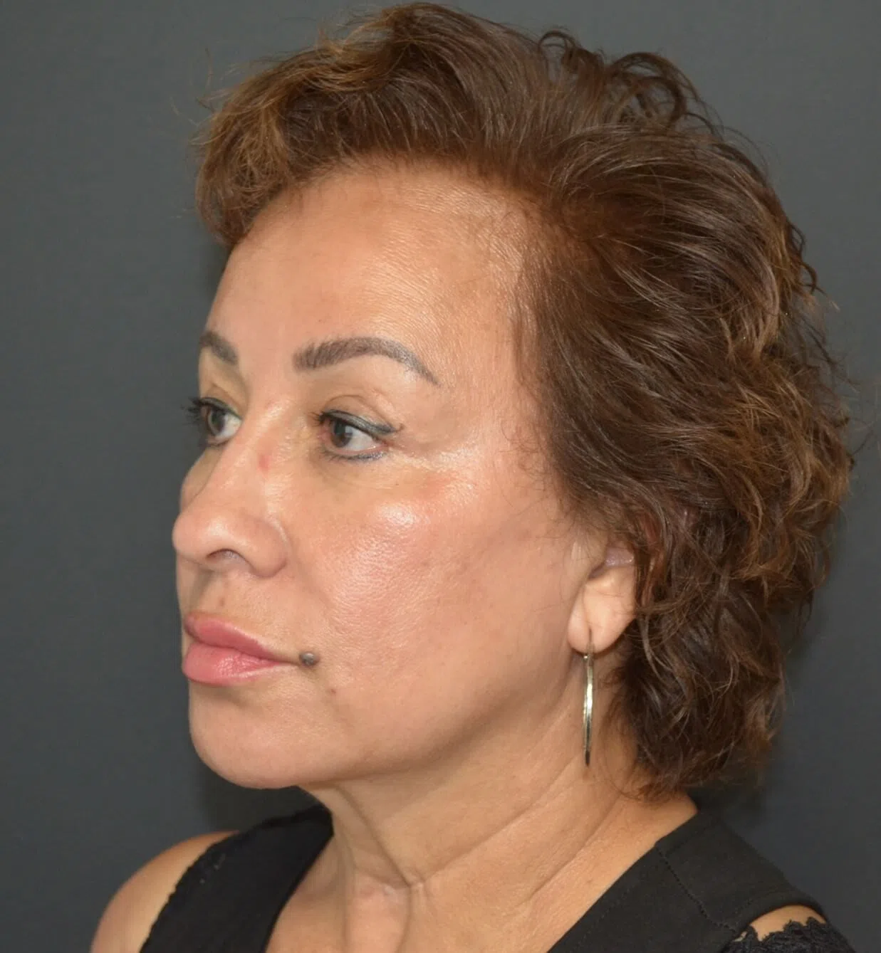 Deep plane facelift before — case 10, Austin TX