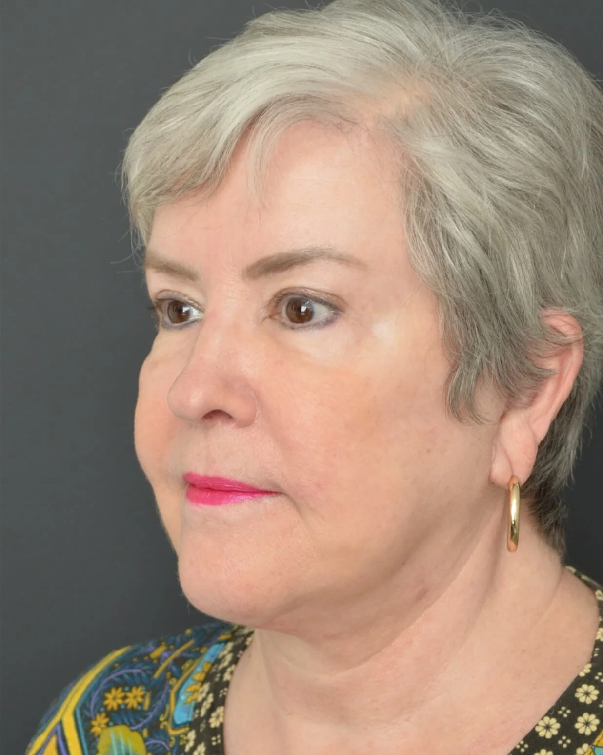 Deep plane facelift after — case 11, Austin TX
