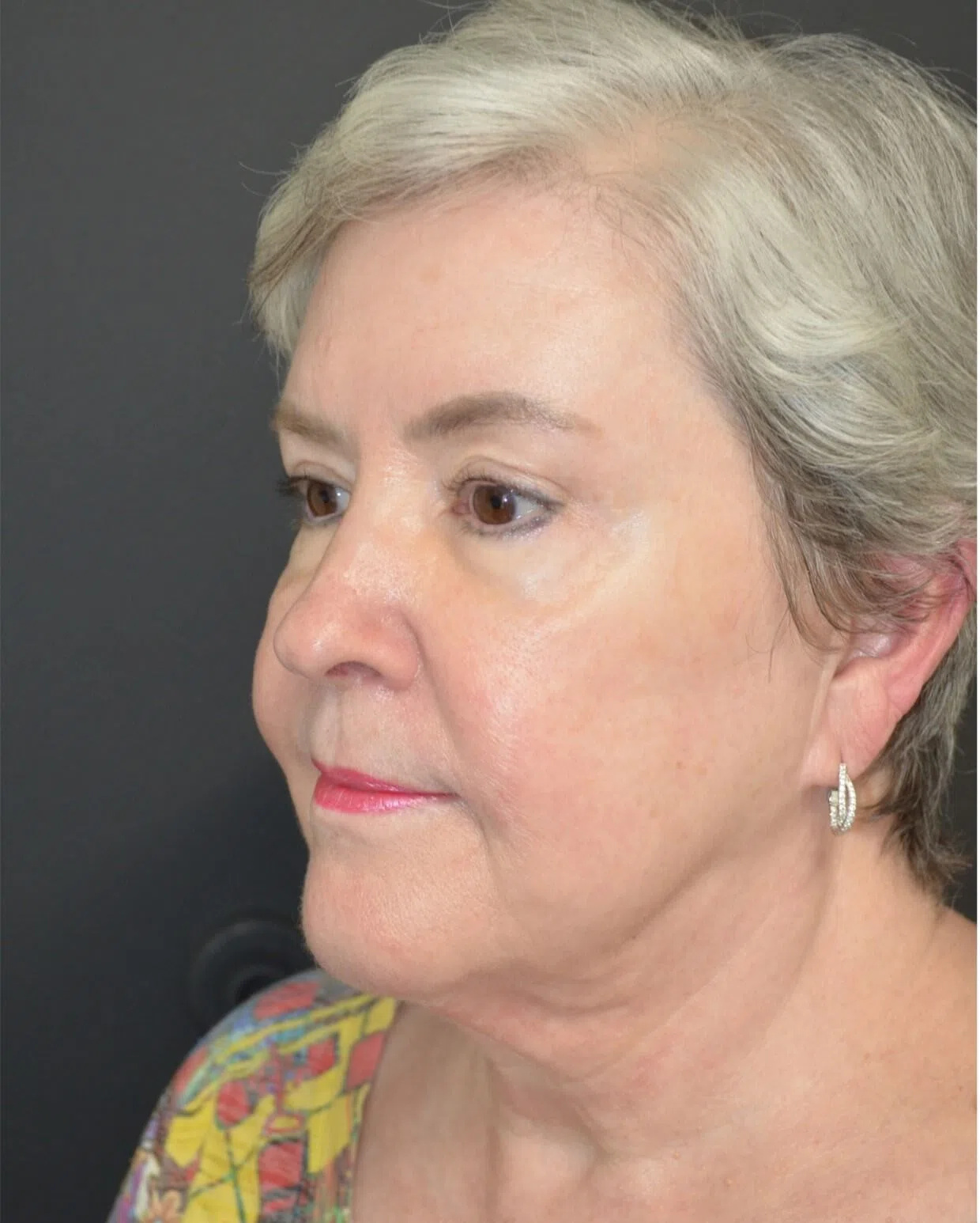 Deep plane facelift before — case 11, Austin TX