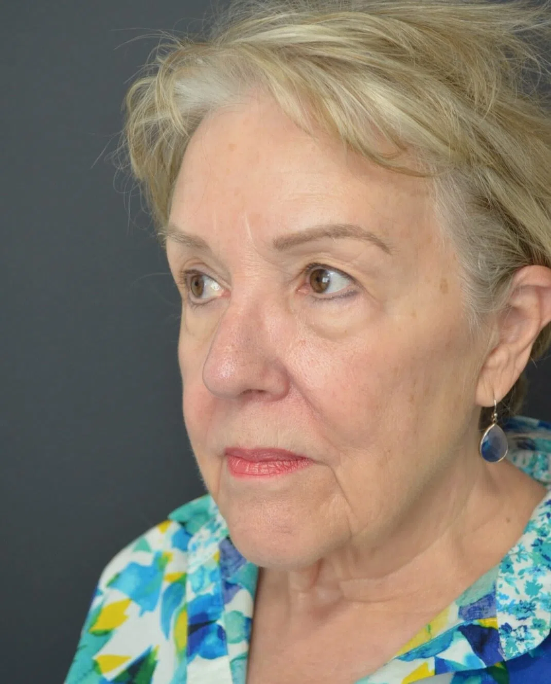 Deep plane facelift before — case 12, Austin TX