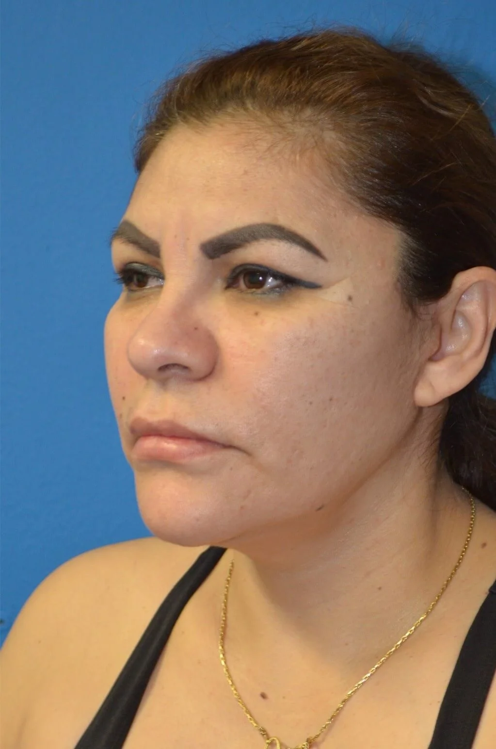 Deep plane facelift after — case 13, Austin TX