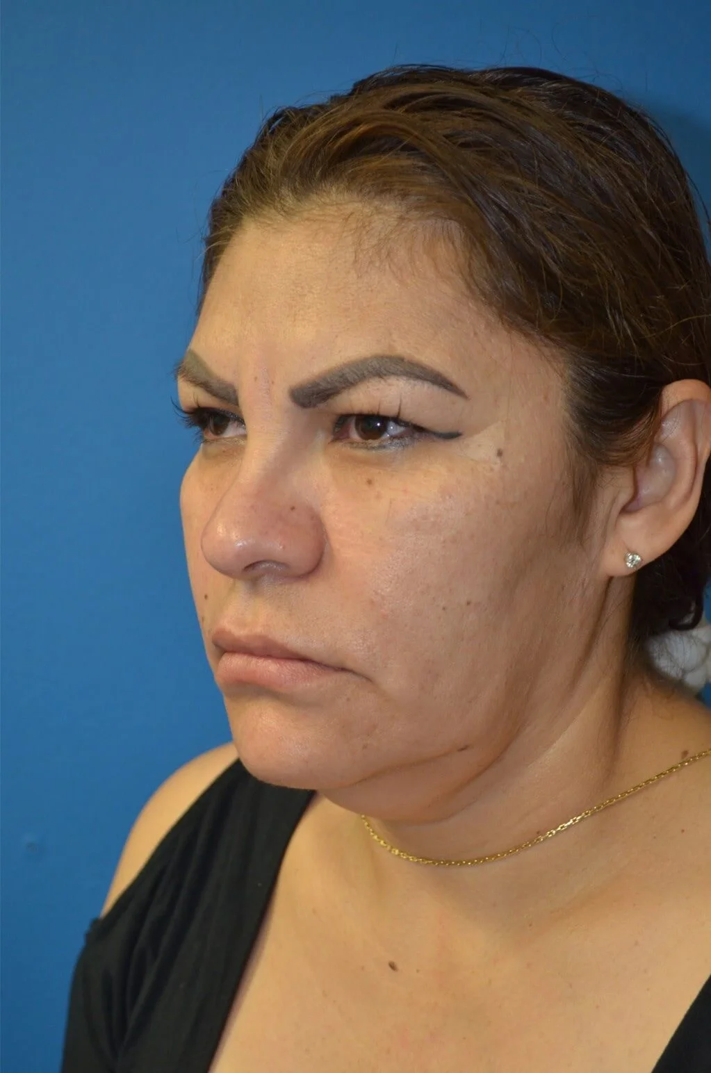 Deep plane facelift before — case 13, Austin TX