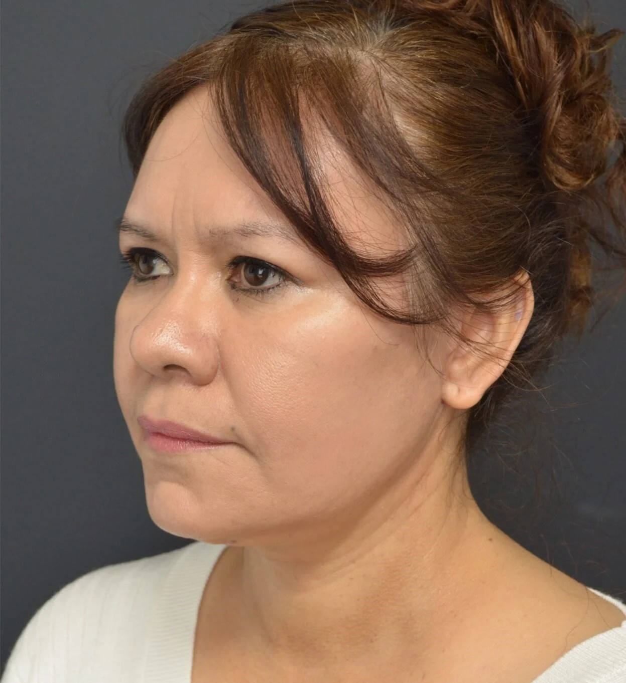 Deep plane facelift after — case 14, Austin TX
