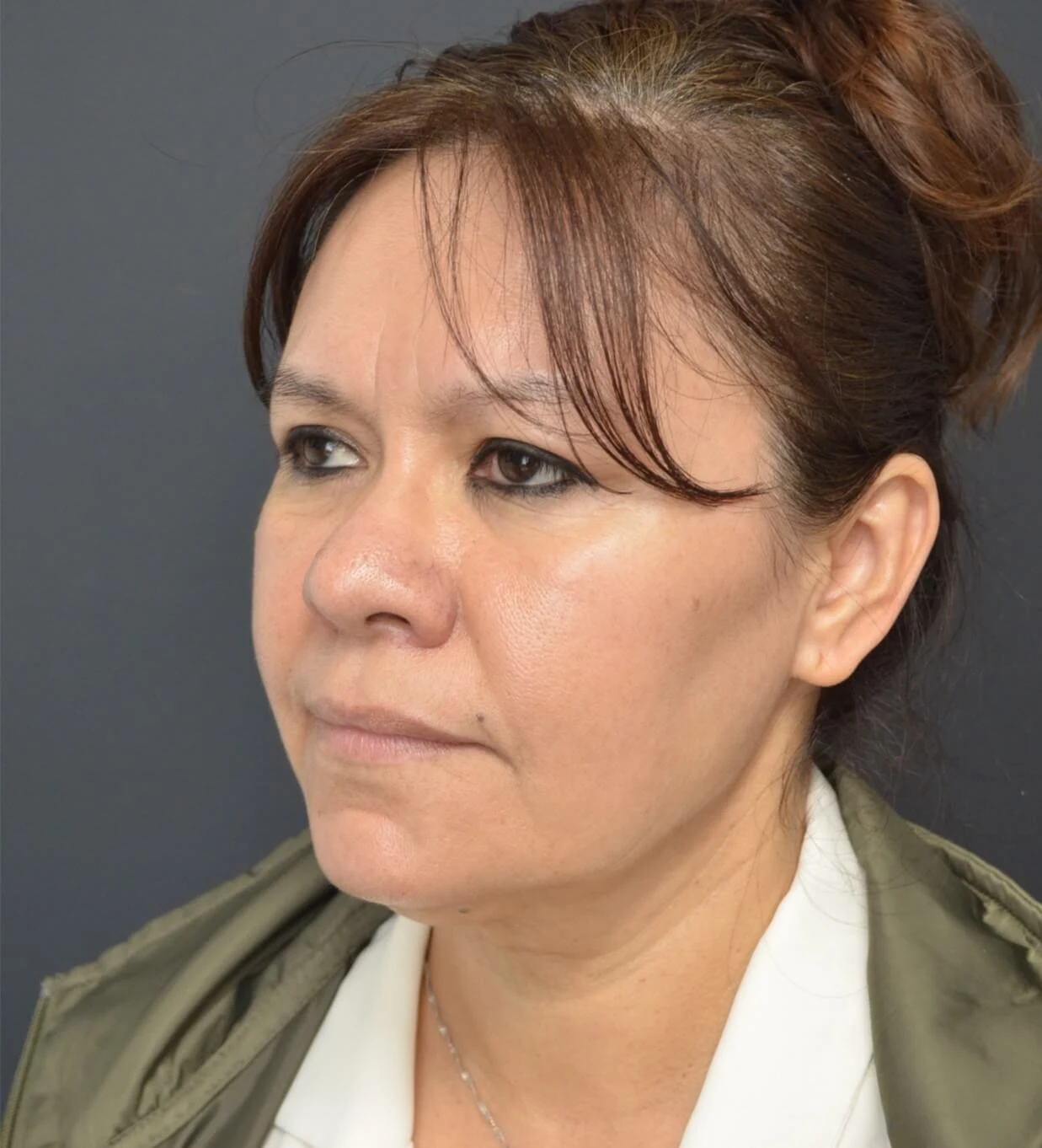 Deep plane facelift before — case 14, Austin TX
