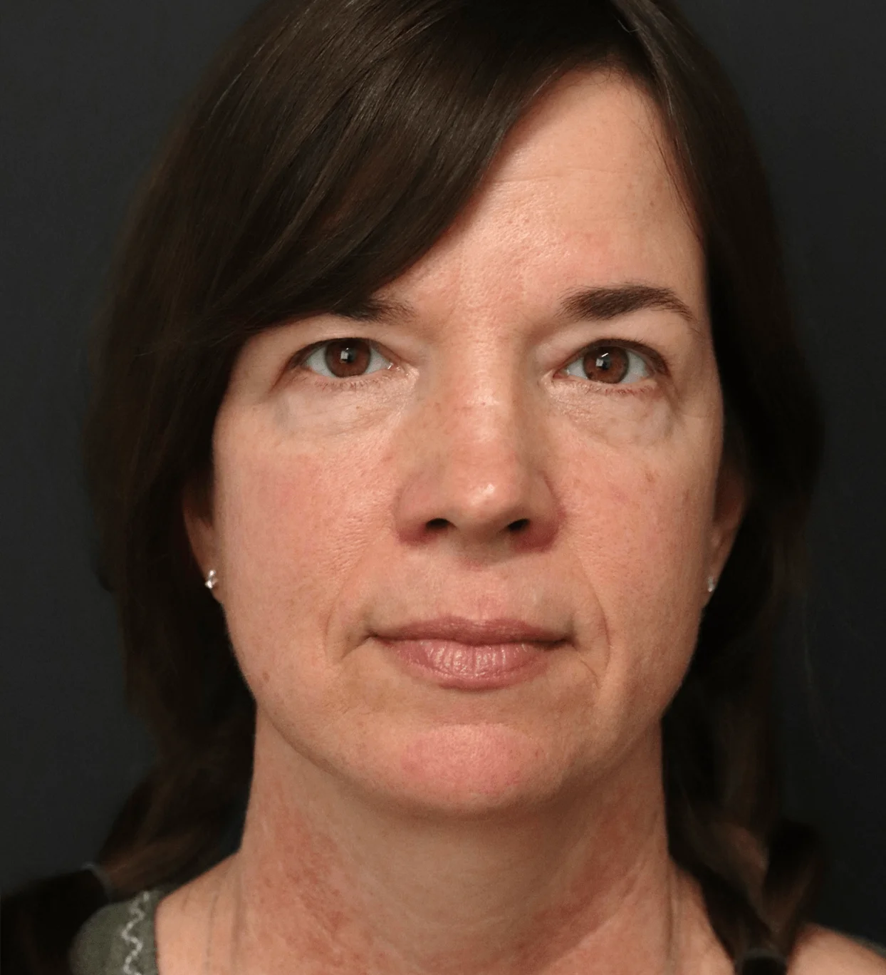 Face and neck lift Austin TX