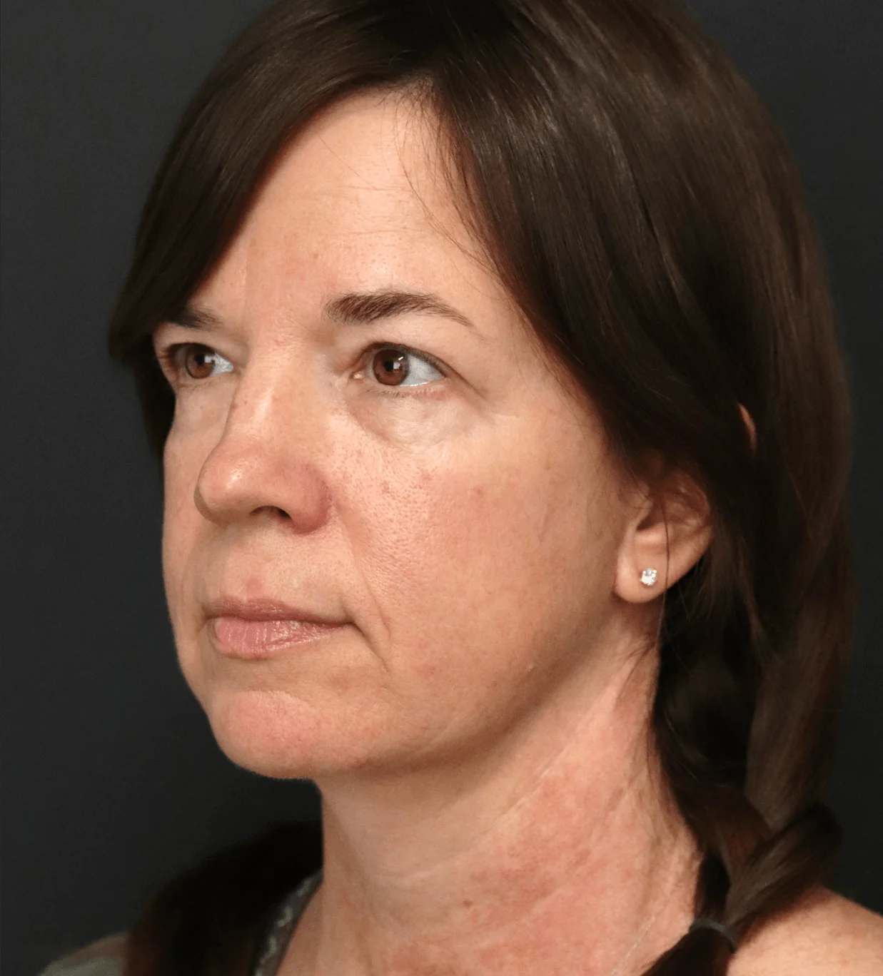 Deep plane facelift after — case 2, Austin TX