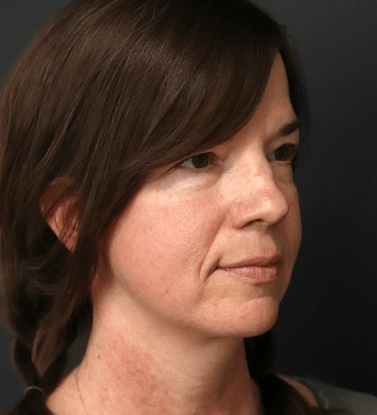 Deep plane facelift after oblique right